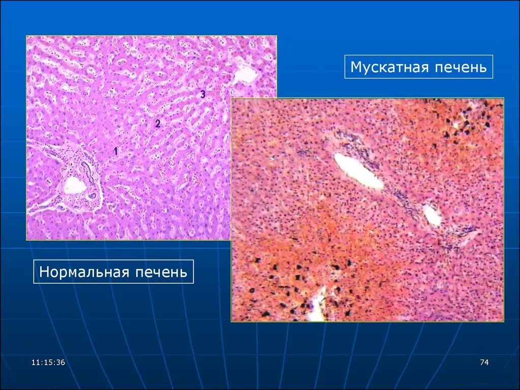 Печень при хроническом венозном застое. Венозное полнокровие печени мускатная печень. Мускатная печень патанатомия. Венозное полнокровие печени макропрепарат. Венозное полнокровие печени гистология.