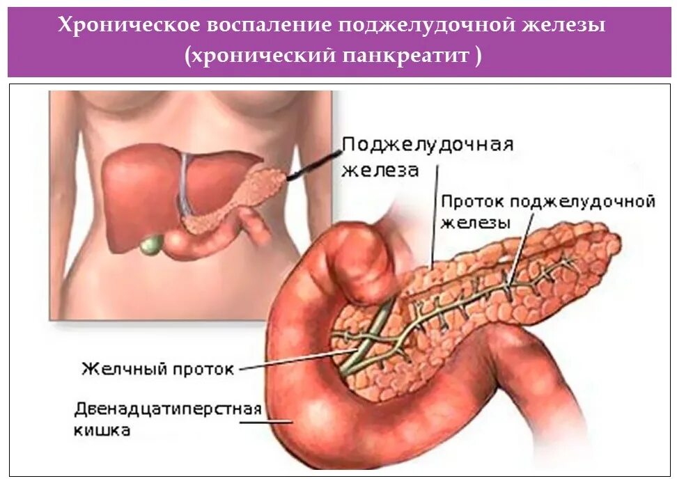 Панкреатит восстановление. Воспаление поджелудочной железы. Панкреатин поджелудочная железа. Хронический панкреатит, изменения поджелудочной железы.