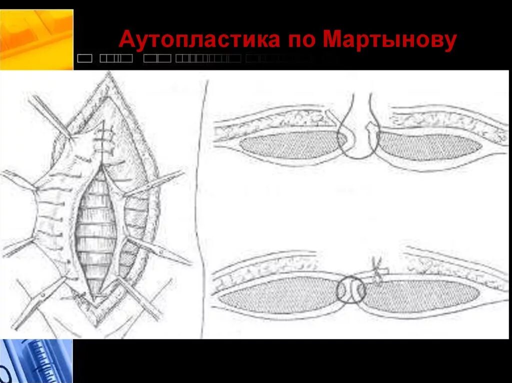 Брюшная стенка после операции. Операция на грыжу и диастаз. Метод Напалкова белой линии живота. Метод Мартынова грыжи белой линии живота. Метод Напалкова грыжи белой линии живота.