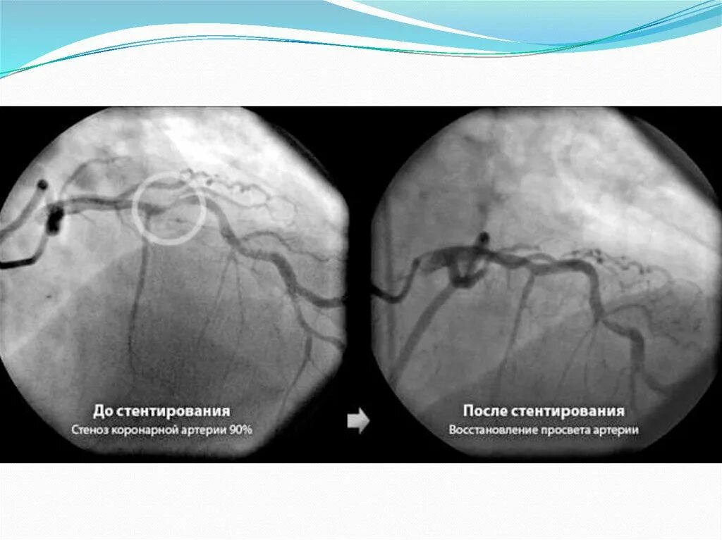Стентирование сосудов последствия. Стентирование коронарных артерий сердца. Коронарное стентирование сосудов сердца операция. Осложнения стентирования коронарных артерий сердца. Стентировние корнараеыц атерии.