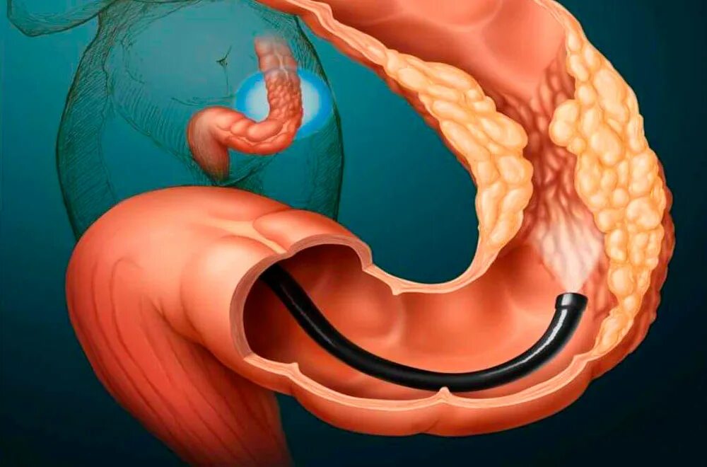 Колоноскопия или фиброколоноскопия. Дивертикулит колоноскопия. Колоноскопия кишечная непроходимость. Дивертикулез толстой кишки колоноскопия. Колоноскопия сигмовидной кишки.