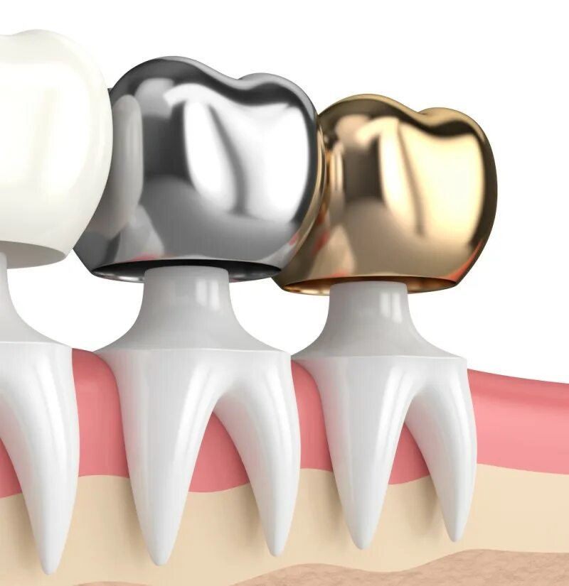Зубная коронка. Металлическая коронка. Металлическая коронка на зуб.