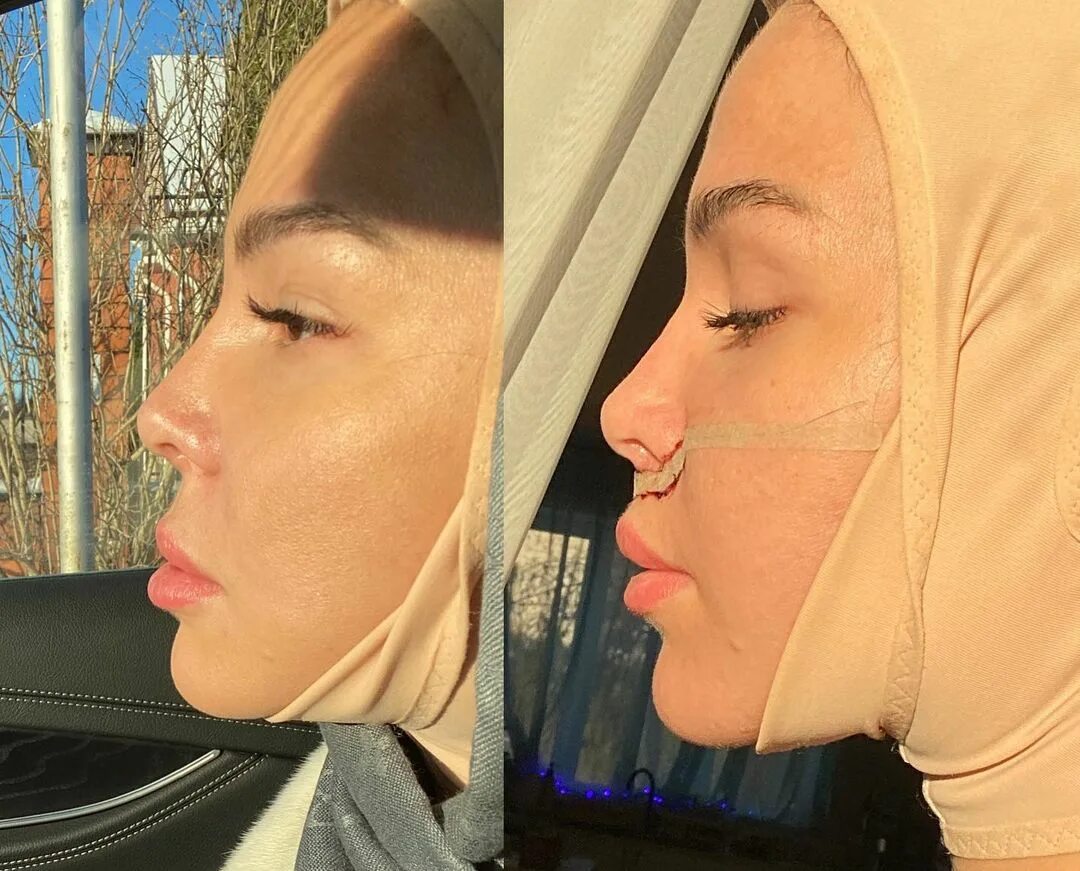 катя колесниченко до операций. ермакова дом 2 до и после. звезды дома 2 до и после пластики. кварацхелия дом 2. участницы дом 2 до и после пластики.