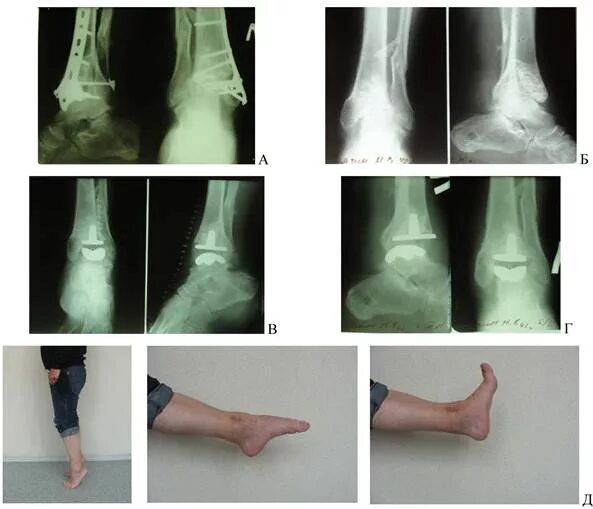 Isolated talonavicular arthrodesis in patients with rheumatoid arthritis of the 