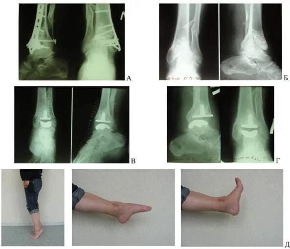 Дома голеностопного сустава. Подтаранный артродез стопы. Остеоартроз голеностопа 2ст. Деформирующий артроз голеностопного сустава рентген. Артродез голеностопного сустава рентген.