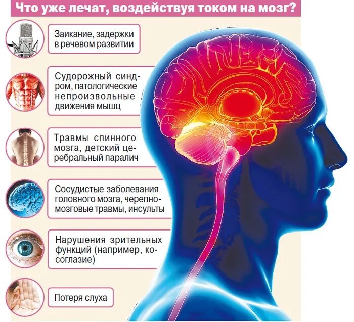 Транскраниальная микрополяризация головного мозга. Инфографика человеческого мозга. Электрическая стимуляция мозга. Мозг и память человека.