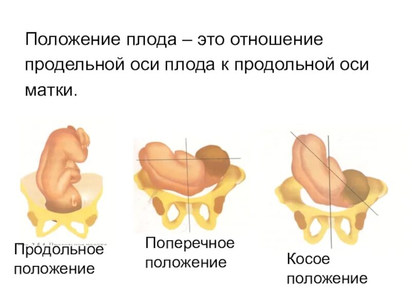 Головное предлежание 2. Продольное поперечное косое положение плода. Продольное переднее положение плода. Предлежание тазовое, положение продольное 2 позиция плода. Продольная ось плода и матки.