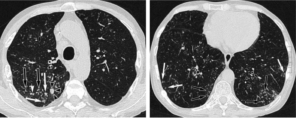 Идиопатический легочный фиброз кт. Системная склеродермия поражение легких кт. Изменения в легких на кт. Бронхоэктазы легкого кт. Интерстициальные заболевания лёгких кт.