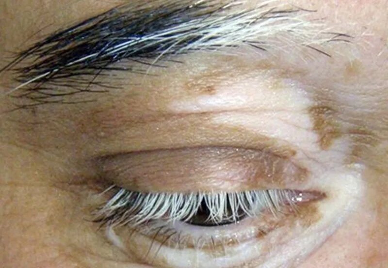 Седые пятна на волосах головы. Причины появления седых волос. Почему волосы белеют. Раннее поседение волос. Оливия манн трихотилломания.