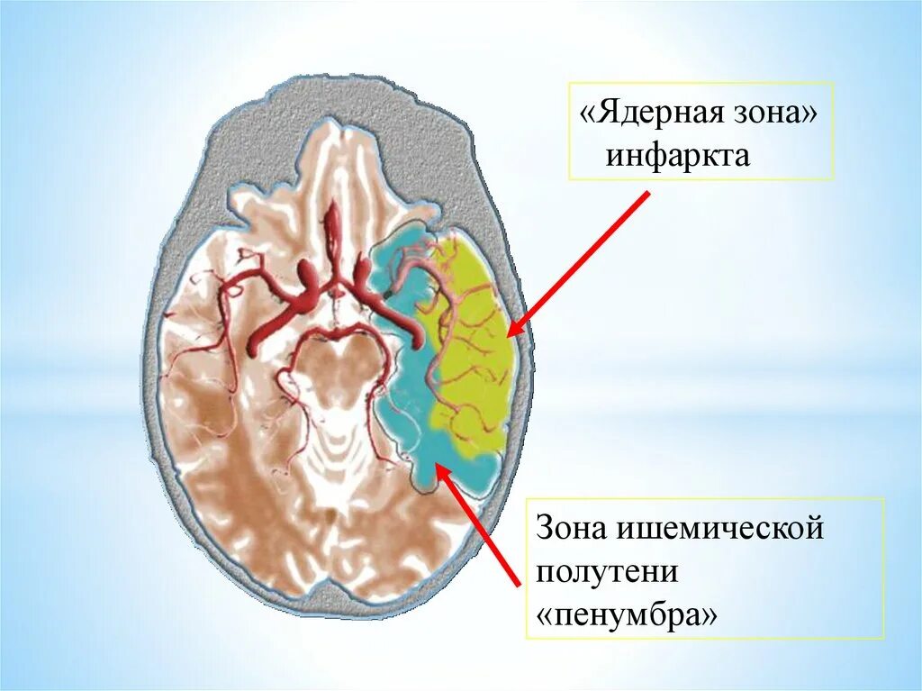 Зона инсульта. Пенумбра зона ишемической полутени. Зоны ишемического инсульта. Ишемический инсульт ишемическая зона.