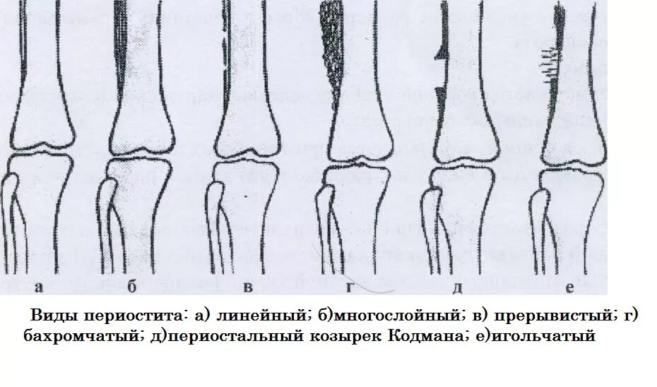 Бахромчатый периостит рентген. Линейный периостит бедренной кости. Периостит большеберцовой кости на рентгене. Линейный периостит большеберцовой кости. Изменение формы кости