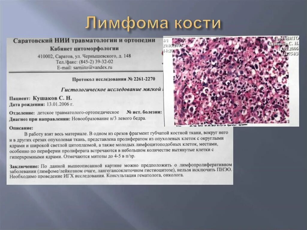 Результаты костного мозга. Злокачественная лимфома гистология. Лимфома Ходжкина гистология. Диффузная лимфома гистология. Неходжкинская лимфома гистология.