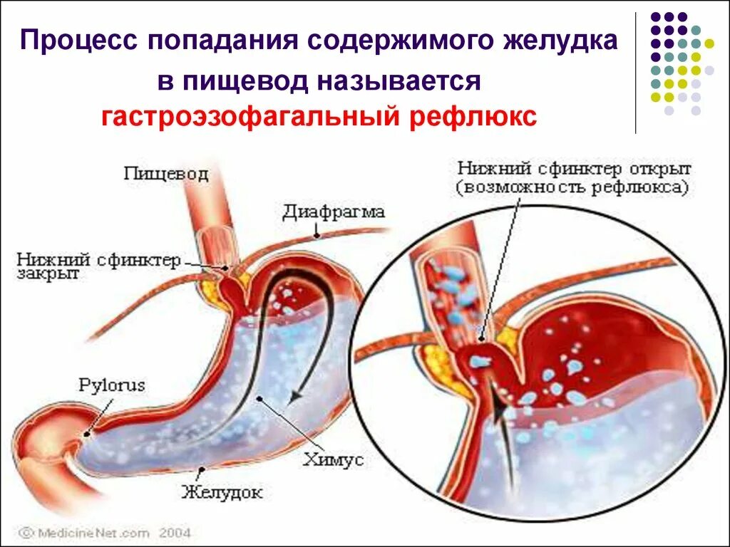 Попадание пищи в пищевод. Желудочно-пищеводный рефлюкс. Рефлюкс желудочного содержимого. Как вода попадает в желудок.