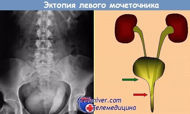 Перегиб мочеточника. Эктопия устья мочеточника рентген. Экстрамуральная эктопия мочеточников. Внесфинктерная эктопия мочеточника. Эктопия мочеточника у детей.