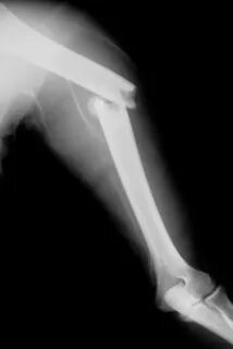 Open fracture