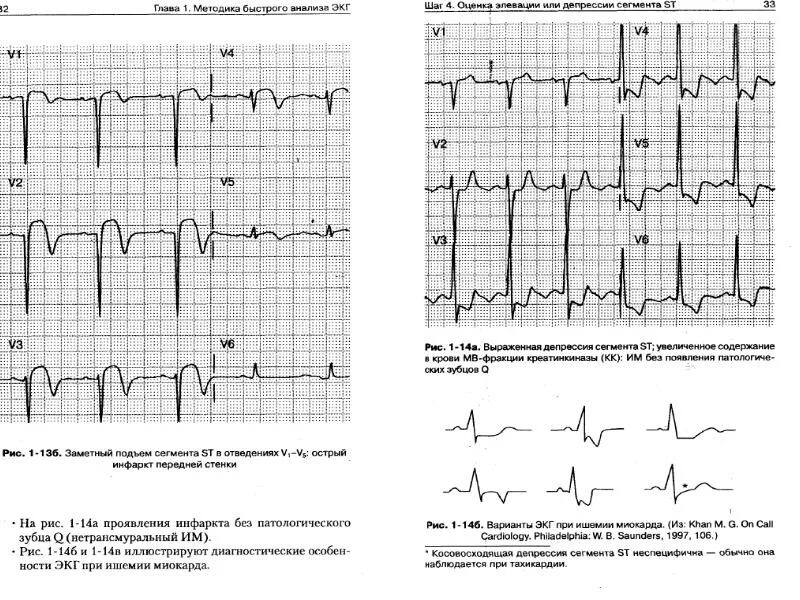 Депрессия сегмента st. Косонисходящая депрессия сегмента St на ЭКГ. Корытообразная депрессия сегмента St на ЭКГ. Депрессия сегмента St на ЭКГ v5 v6. Снижение сегмента St на ЭКГ причины.
