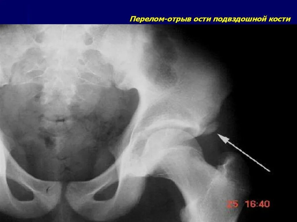 Перелом ости подвздошной кости рентген. Перелом передней верхней ости подвздошной кости. Краевые переломы костей таза рентген. Краевой перелом крыла подвздошной кости.
