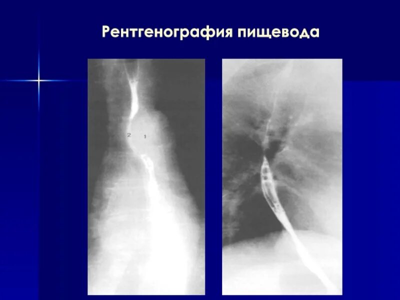 Пищевод отзывы. Штопорообразный пищевод рентген. Рентгеноскопия пищевода. Рентгенограмма пищевода. Отделы пищевода рентген.