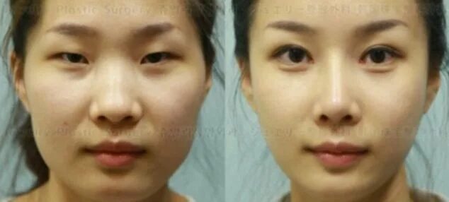 Операция по разрезу глаз до и после Chinese women are crazy about getting double eyelid surgery. Plastic surgery pho