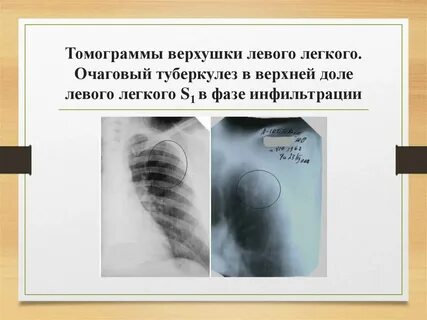 Очаговый легких в фазе инфильтрации
