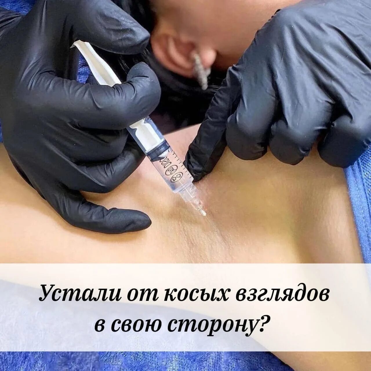 Зачем ботокс в подмышки. Зачем ботокс в подмышки