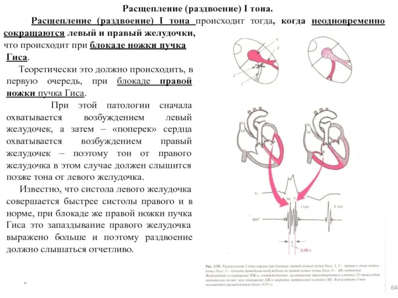 Блокада правого желудочка. Расщепление и раздвоение 1 тона. Расщепление 1 тона причины. Расщепление и раздвоение тонов сердца пропедевтика. Правый пучок Гиса и левый желудочек.