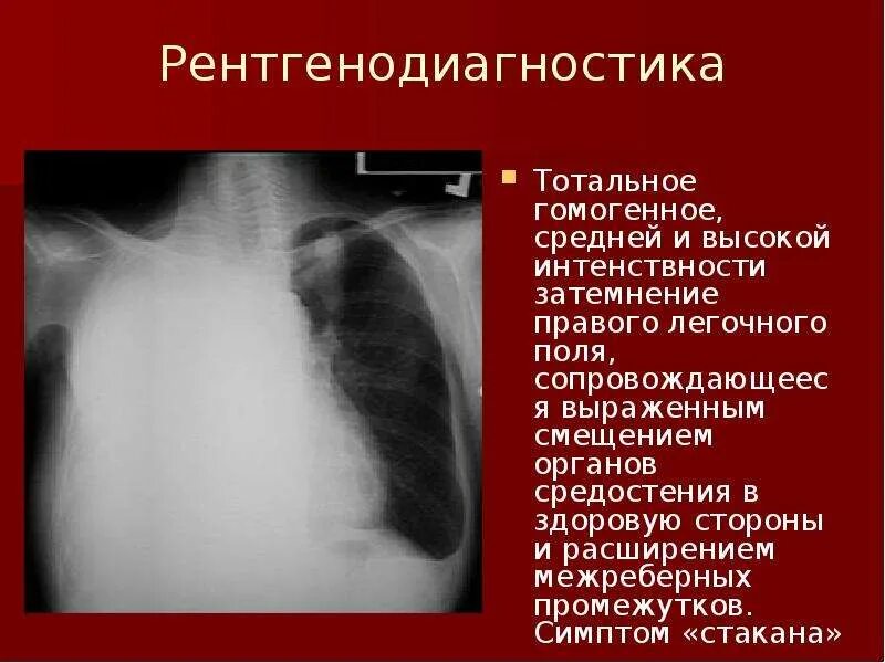 Тотальное отсутствие это. Тотальное затемнение легкого со смещением средостения. тотальное затемнение легочного поля. тотальное и субтотальное затемнение легочного поля. синдром смещения средостения.