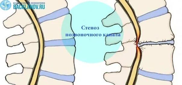 Стеноз позвоночного канала l2-l3. Стеноз позвоночного канала с4 с5. Степени стеноза позвоночного канала. Центральный стеноз позвоночного канала.