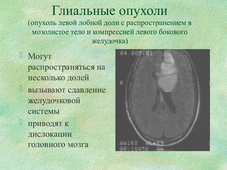 Опухоли желудочков. Опухоли боковых желудочков головного мозга. Объемное образование боковых желудочков головного мозга. Опухоль левой лобной доли. Опухоль лобной доли головного мозга.