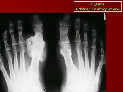 Рентгенологические признаки подагры