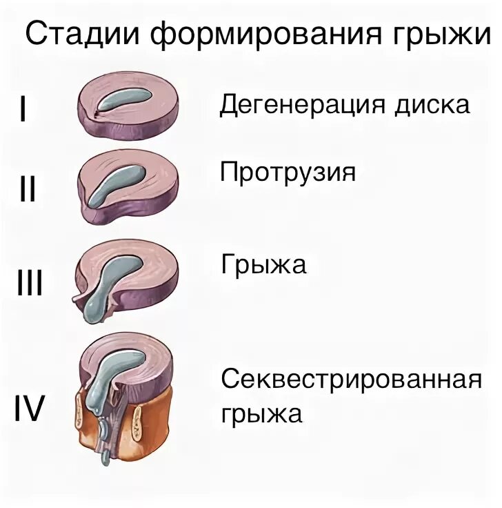 Стадии грыжи позвоночника. Дегенерация межпозвоночного диска. Стадии развития грыжи позвоночника. Грыжа протрузия анатомия.