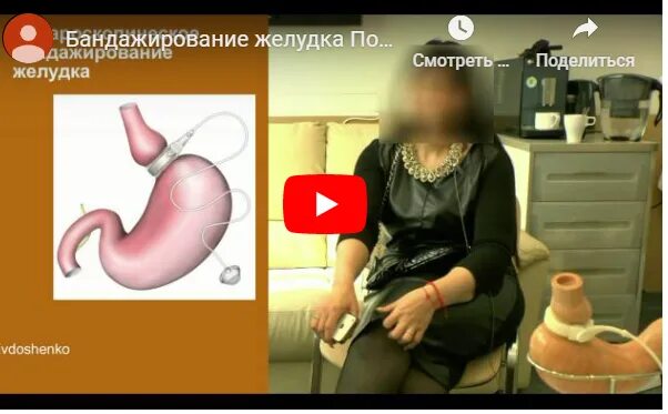Бандажирования желудка отзывы. Бандаж на желудок для похудения. Бандажирование желудка. Уменьшение объема желудка. Лапароскопическое бандажирование желудка.