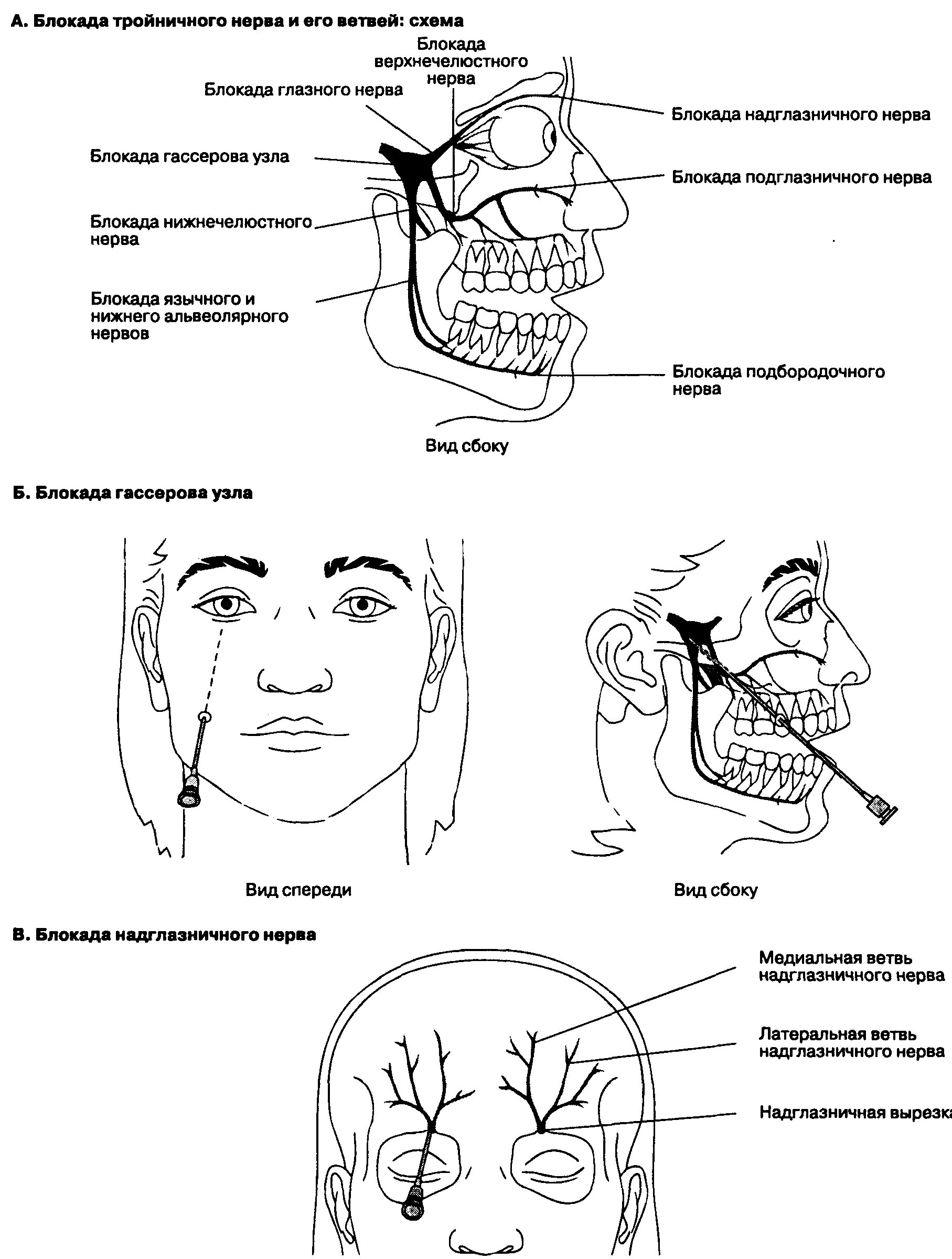 Блокада тройничного. Техника блокады ветвей тройничного нерва. Анестезия 2 ветви тройничного нерва. Блокада ветвей тройничного нерва топографическая анатомия. Схема блокады ветвей тройничного нерва.