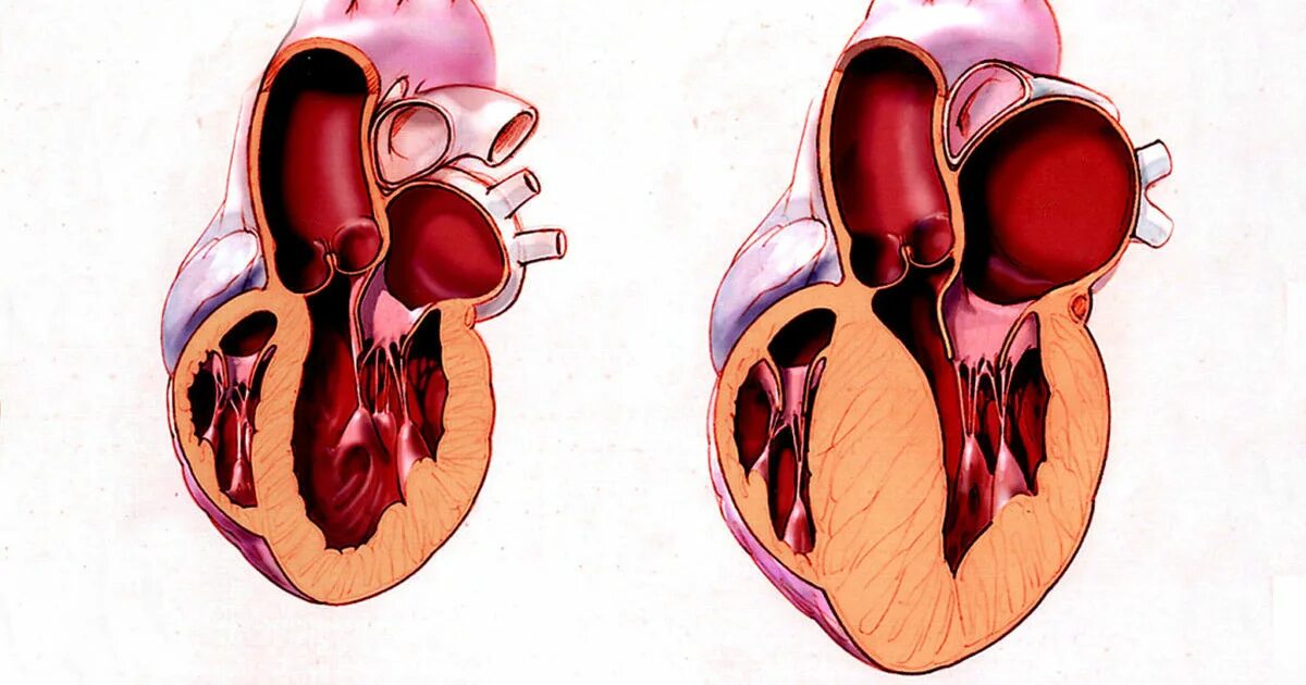 Гипертрофия миокарда предсердий. Гипертрофия левого желудочка при гипертонии. Гипертрофия левого желудочка легочное сердце. Гипертрофия левого желудочка сердца рентген. Гипертрофия левого предсердия и правого желудочка.