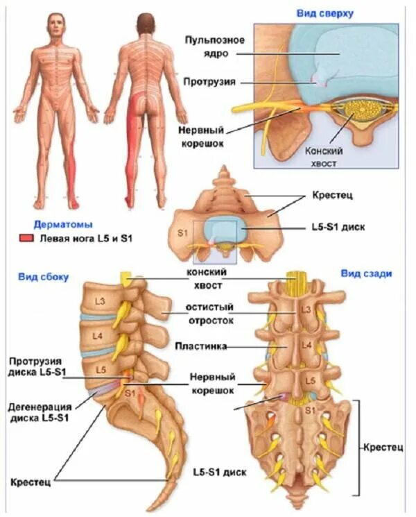 L4 отдел позвоночника. Протрузия дисков поясничного отдела l5-s1. Протрузии l4 l5 l5 s1 пояснично-крестцового отдела. Протрузия дисков позвоночника l4-5. Диски l5-s1 в позвоночнике.