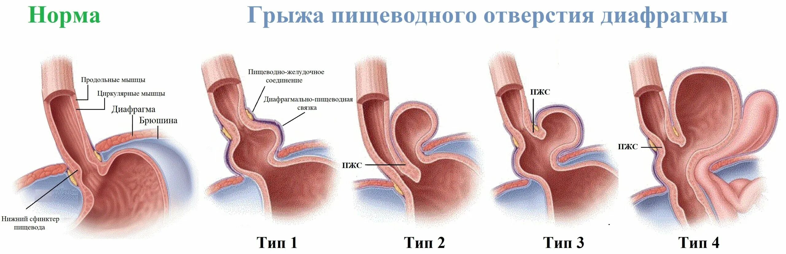 Гпод 1