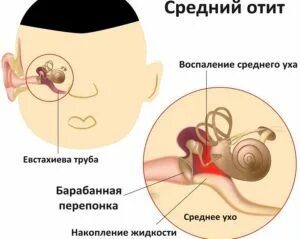 Симптомы отита у ребенка 1