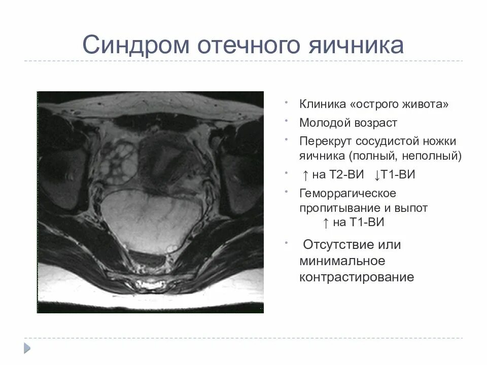 Киста яичника на мрт. Апоплексия яичника мрт.