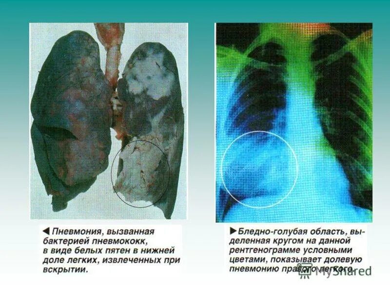 Легкие после поражения. Гипостатическая пневмония макропрепарат.