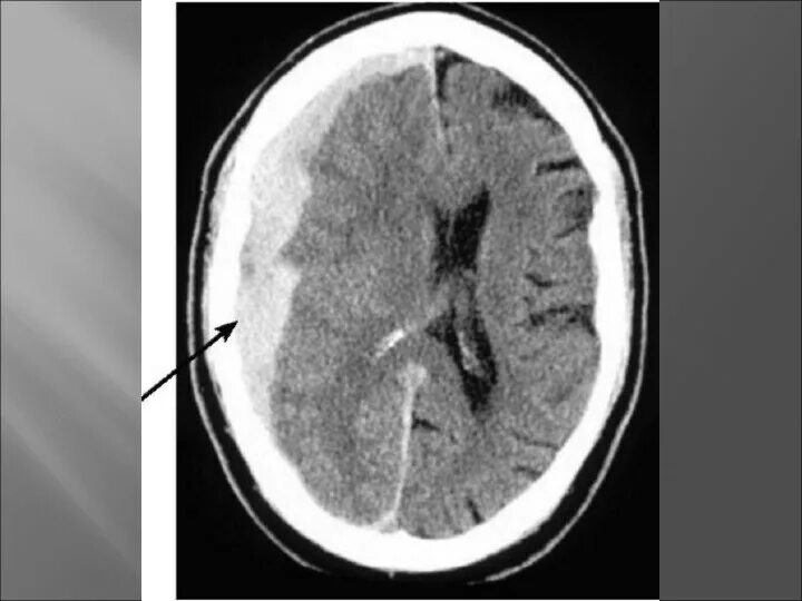Инфаркт мозжечка артерии. Ишемический инсульт варолиев моста. Инсульт мозжечка кт. Инфаркт мозжечка кт. Гематомы при гемофилии.