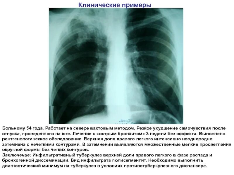 Инфильтративный туберкулез в фазе распада и обсеменения кт. Инфильтративный туберкулез в фазе распада клиника. Инфильтративный туберкулез в фазе инфильтрации. Инфильтративный туберкулез в фазе распада кт.