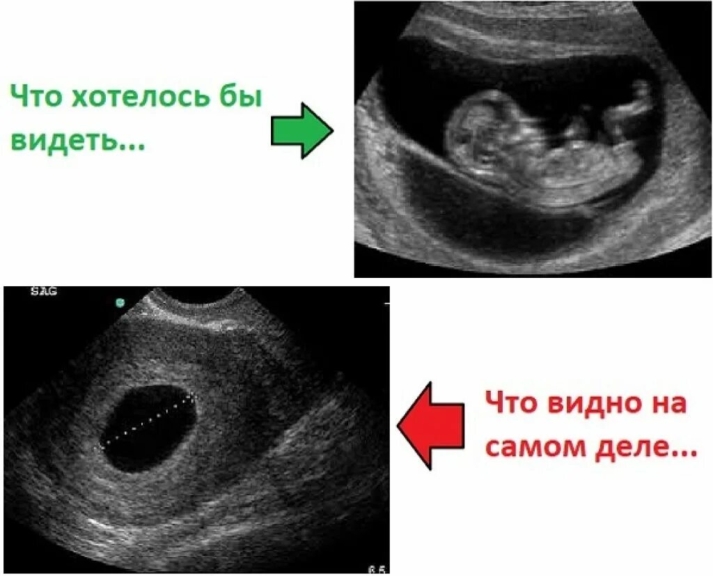 Причины неразвивающейся беременности. Неразвивающаяся беременность анэмбриония. Неразвивающаяся беременность 7 недель УЗИ. Неразвивающаяся беременность на ранних сроках УЗИ.