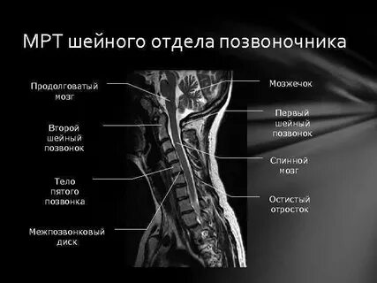 Мрт спинного мозга шейного отдела