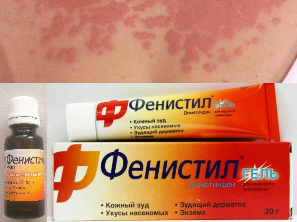 Как быстро убрать зуд. Мазь от высыпаний на коже. аллергия на коже препараты. аллергический зуд кожи. .от аллергия покраснения на коже.