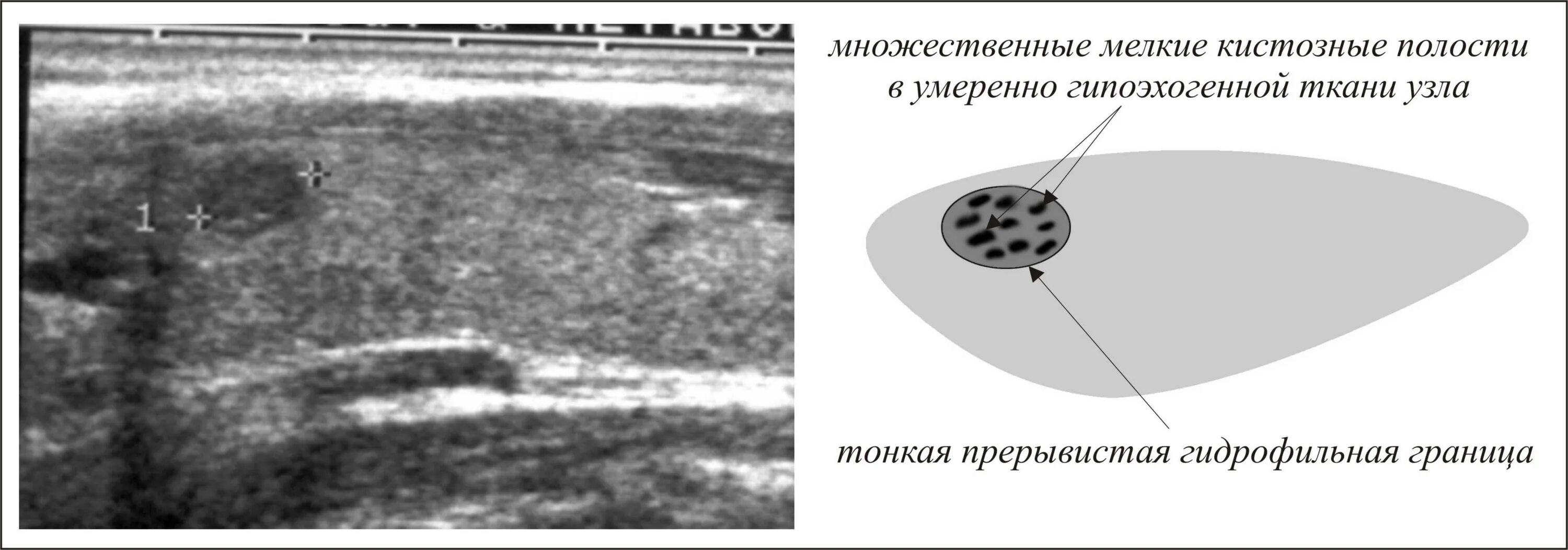 Кистозный солидный образование молочные железа. УЗИ щитовидной железы гипоэхогенное образование. Гипоэхогенный узел щитовидной. Гипоэхогенное образование неоднородной структуры в щитовидной. Гипоэхогенные узлы на УЗИ щитовидной железы.