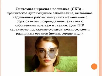 Что такое волчанка простыми словами
