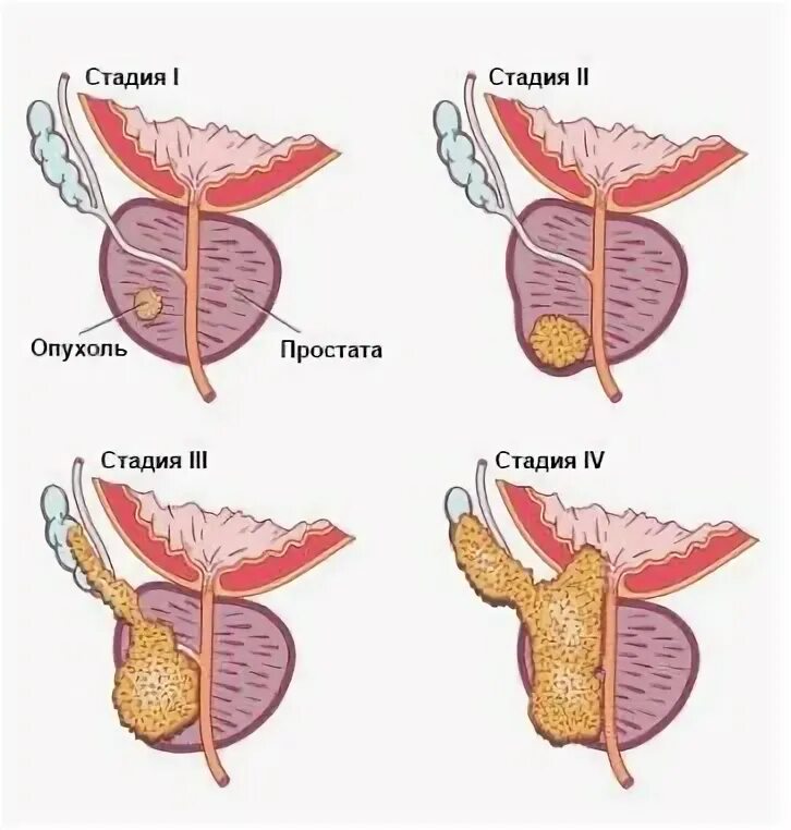 Опухоли предстательной железы классификация. Аденокарцинома предстательной железы. ТНМ классификация предстательной железы. Аденокарцинома предстательной железы классификация. Степени простатита