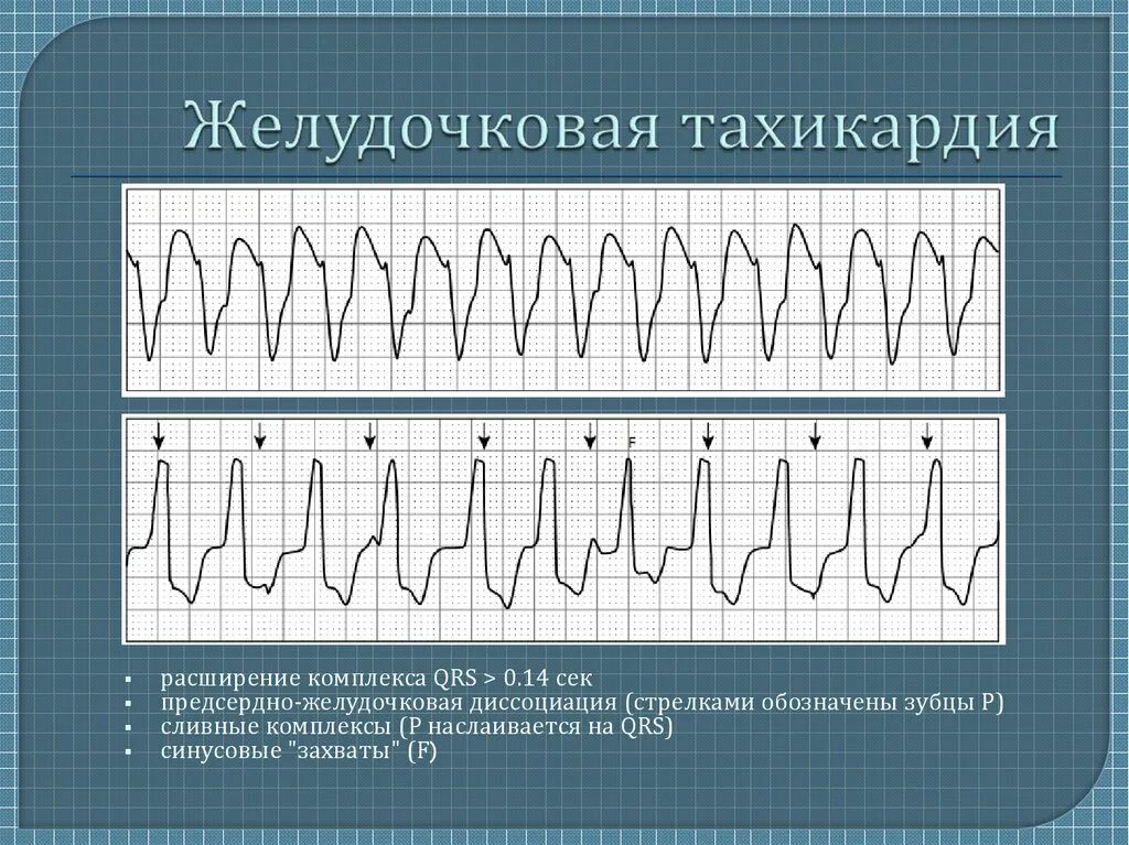 Желудочковая тахикардия на экг. Пароксизмальная желудочковая тахикардия на ЭКГ. Многоформная желудочковая тахикардия.