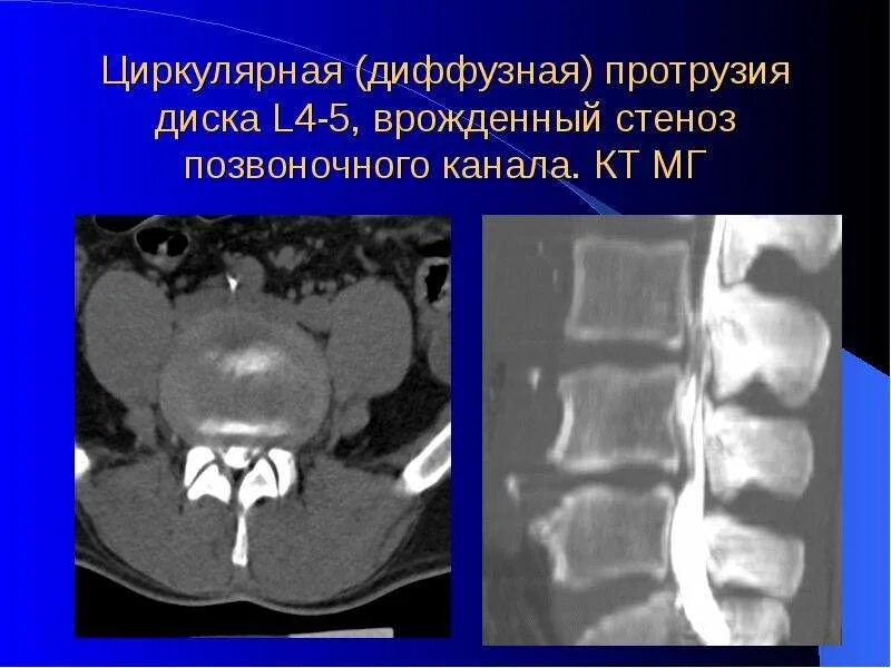 Диффузное выбухание межпозвоночного. Дорсо циркулярная протрузия. Дорзальная протрузия. Выбухание l4-5 диска. Диффузное выбухание диска.