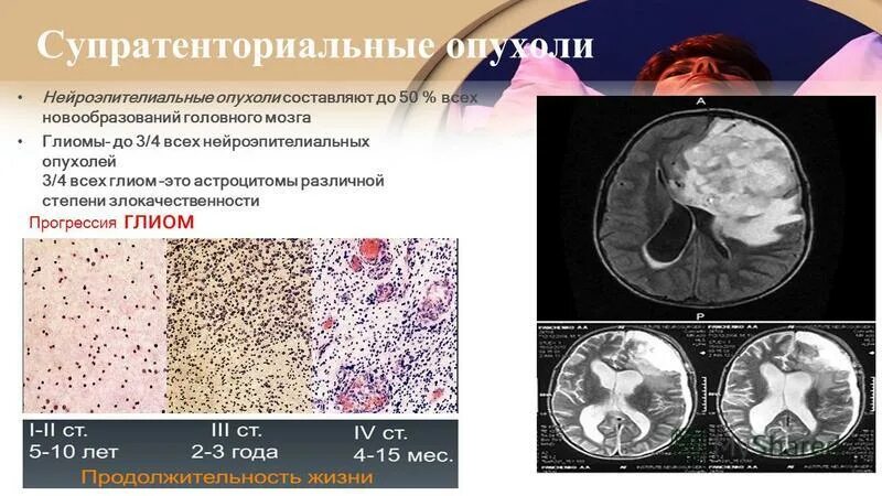 Субтенториальные опухоли. Супратенториальные опухоли головного мозга. Опухоль головного мозга глиома. Суб и супратенториальных образований головного мозга. Диагноз опухоли головного